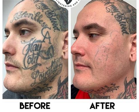 Tattoo Removal in Metro Manila, Philippines • Check Prices.